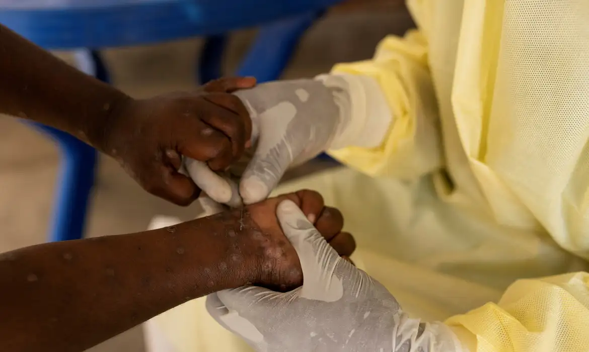 Brasil registra 88 casos de Mpox em 2026