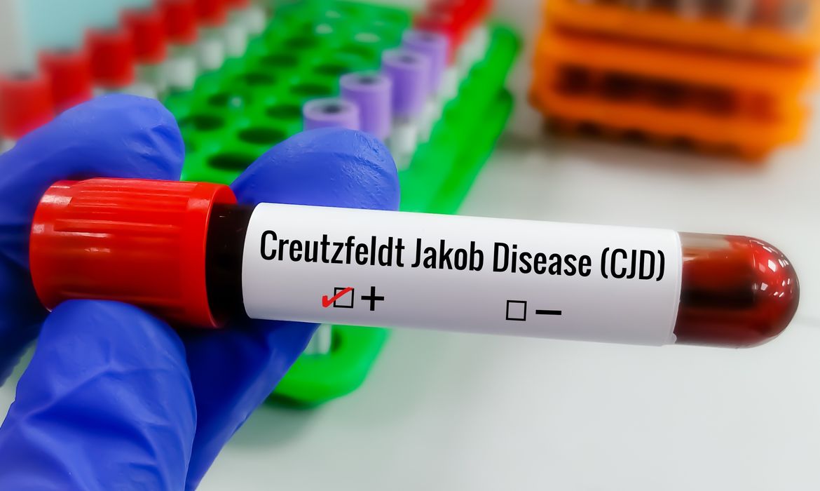 Entenda Doença de Creutzfeldt-Jakob, diagnóstico
