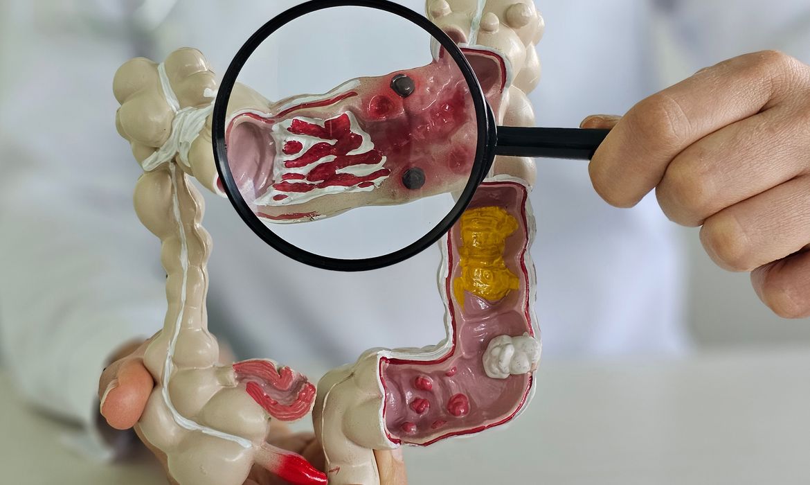 Em 13 anos, doença inflamatória intestinal